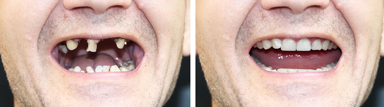 The image shows a person with an open mouth, displaying two different teeth conditions  one side has a full set of natural teeth while the other side lacks any teeth.